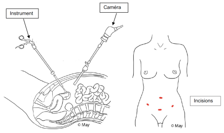 Laparoskopischer Ansatz