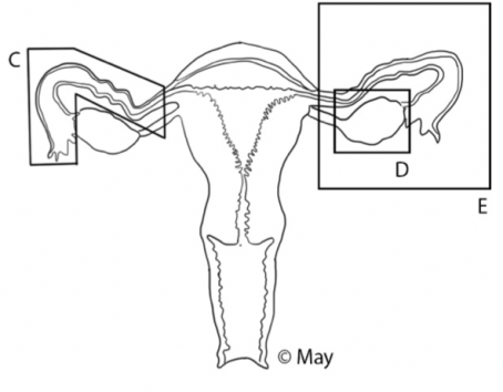 C-Salpingektomie_D-Ovariektomie_E-Annexectomie
