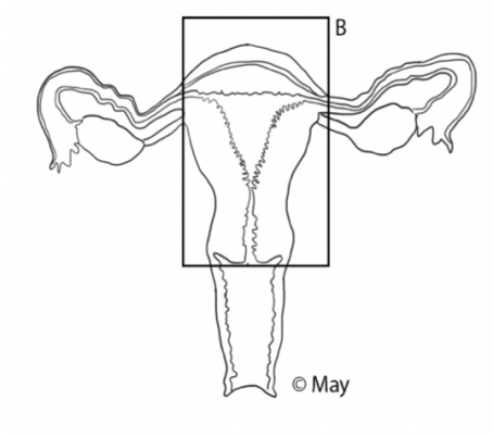 Totale Hysterektomie